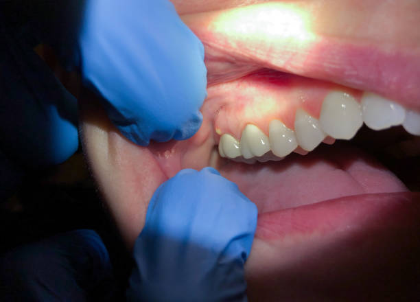 Best Broken or Chipped Tooth Repair in Wharton, NJ